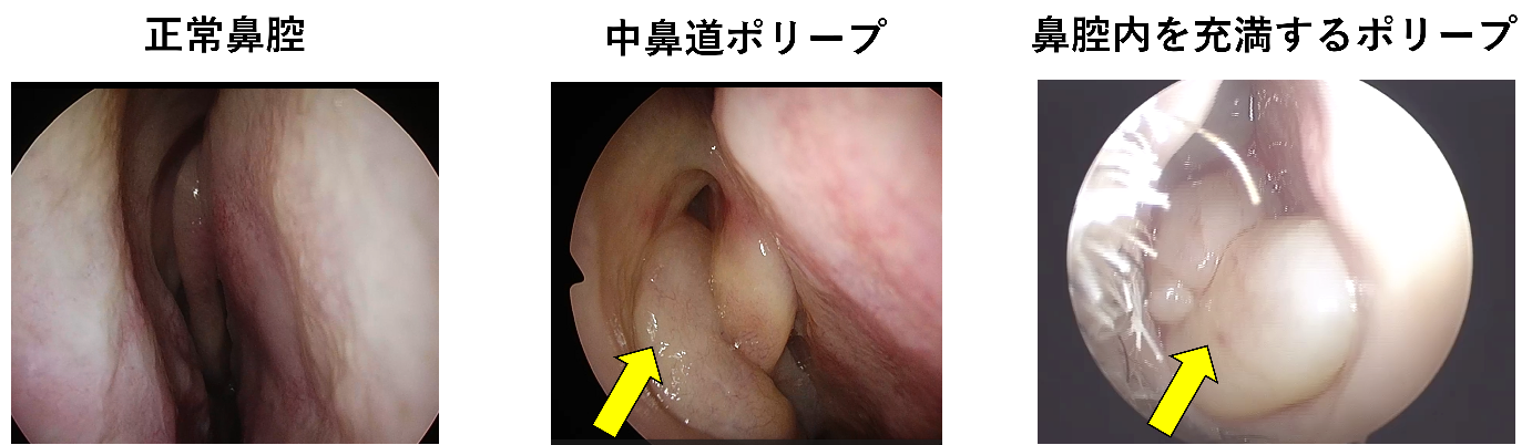 鼻茸（鼻ポリープ）とは